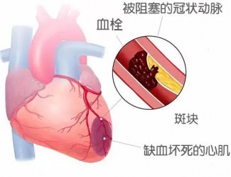 血栓的形成原因及后果，如何預防血栓導致的疾病